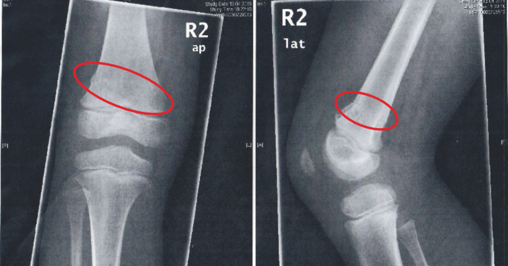 Röntgenbild mit Oberschenkelbruch